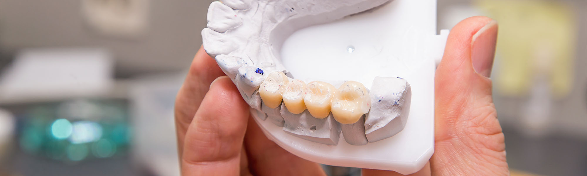What Are Dental Bridges?
