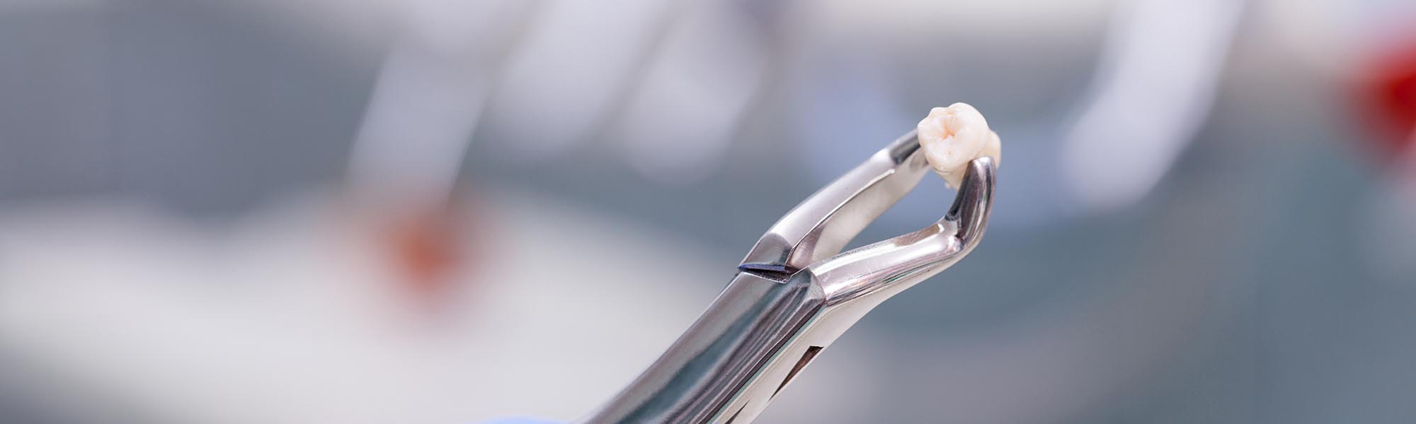 What You Should Know About Tooth Extractions