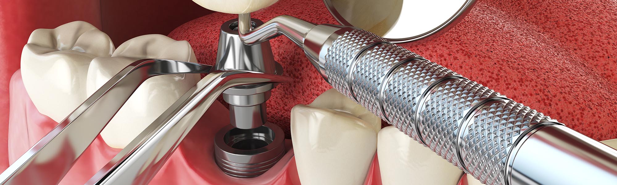 Who is a Candidate for Dental Implants